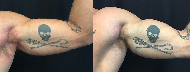Trusculpt Flex Body Sculpting 4 Trusculpt-flex Before & after Treatment result in Brooklyn NY by Skin Envy Cosmetic and Laser Center