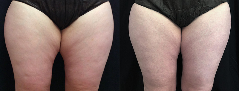 Trusculpt-id Before & after Treatment in Brooklyn NY by Skin Envy Cosmetic and Laser Center