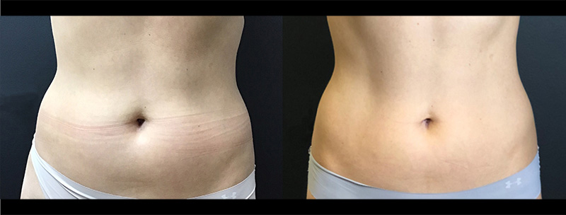 Trusculpt ID Before & after Treatment in Brooklyn NY by Skin Envy Cosmetic and Laser Center