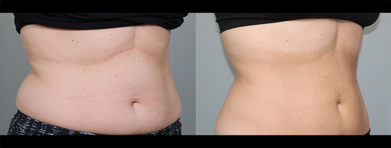 Trusculpt ID stomach Before & after Treatment in Brooklyn NY by Skin Envy Cosmetic and Laser Center