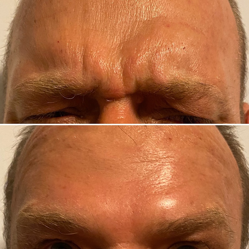 Wrinkle-relaxers Before & after Treatment result in Brooklyn NY by Skin Envy Cosmetic and Laser Center