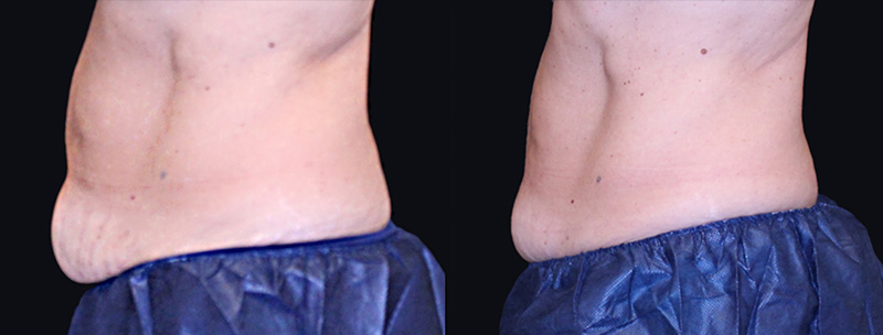 Trusculpt ID Before & after Treatment result in Brooklyn NY by Skin Envy Cosmetic and Laser Center