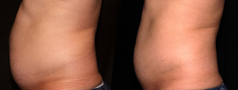 Trusculpt ID Body Contouring 2 Trusculpt ID Before & after Treatment in Brooklyn NY by Skin Envy Cosmetic and Laser Center