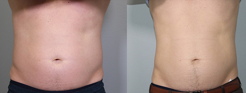 Trusculpt ID Before & after Treatment result in Brooklyn NY by Skin Envy Cosmetic and Laser Center